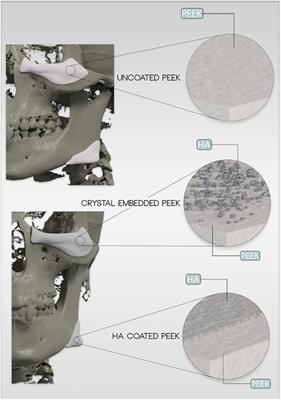 Surface modification of PEEK implants for craniofacial reconstruction and aesthetic augmentation—fiction or reality?